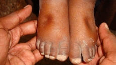 Biến chứng suy thận trong bệnh đái tháo đường