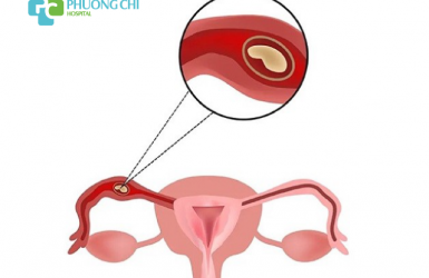 Chăm sóc và sinh hoạt sau mổ thai ngoài tử cung